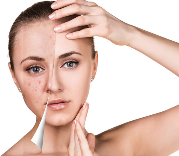 Accredited Microneedling Course