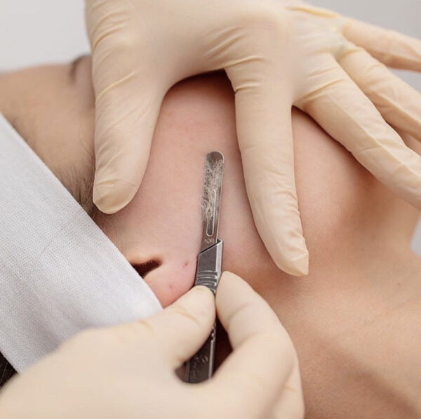Accredited Dermaplaning Course